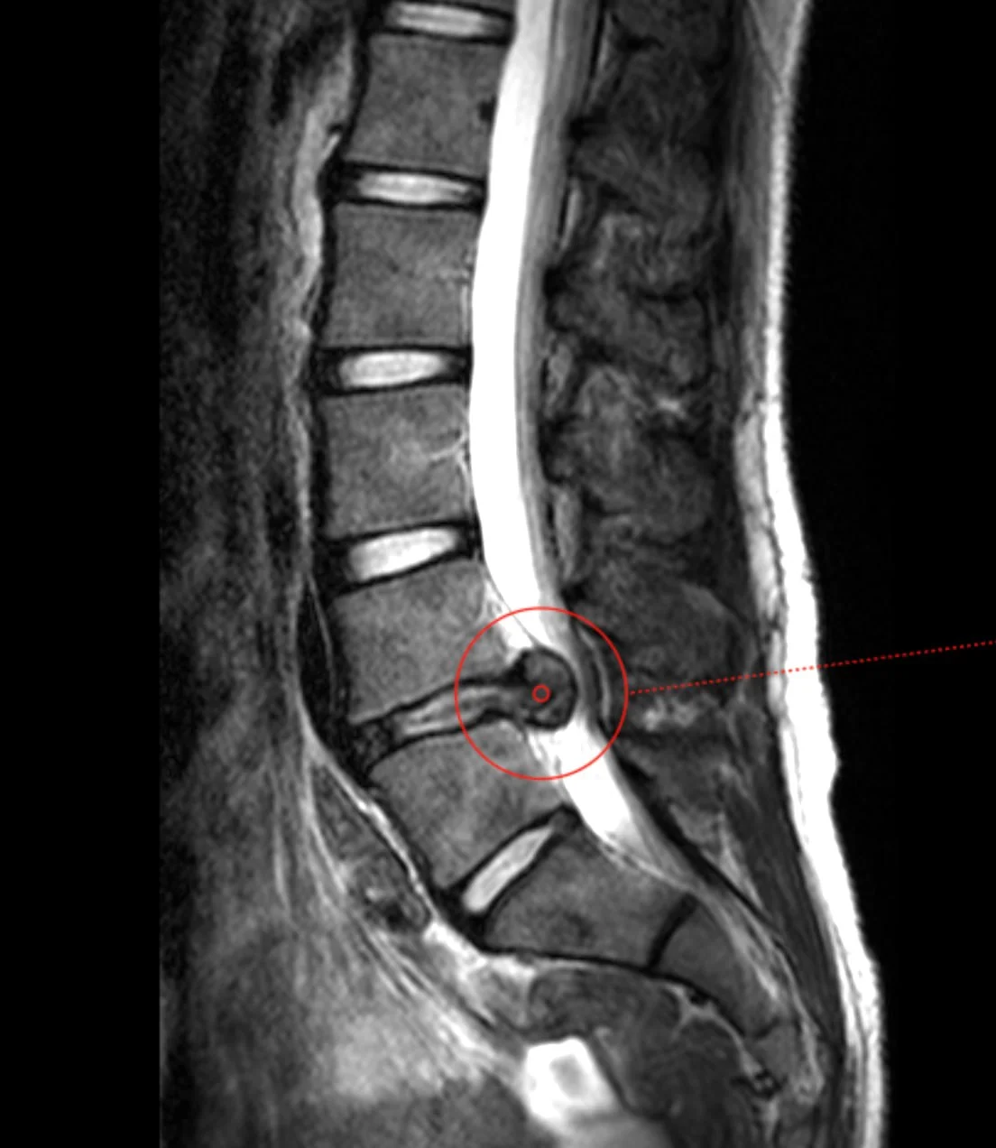 Sagittal MRI of the lumbar spine showing a large disc herniation at L4-5, marked with a red circle