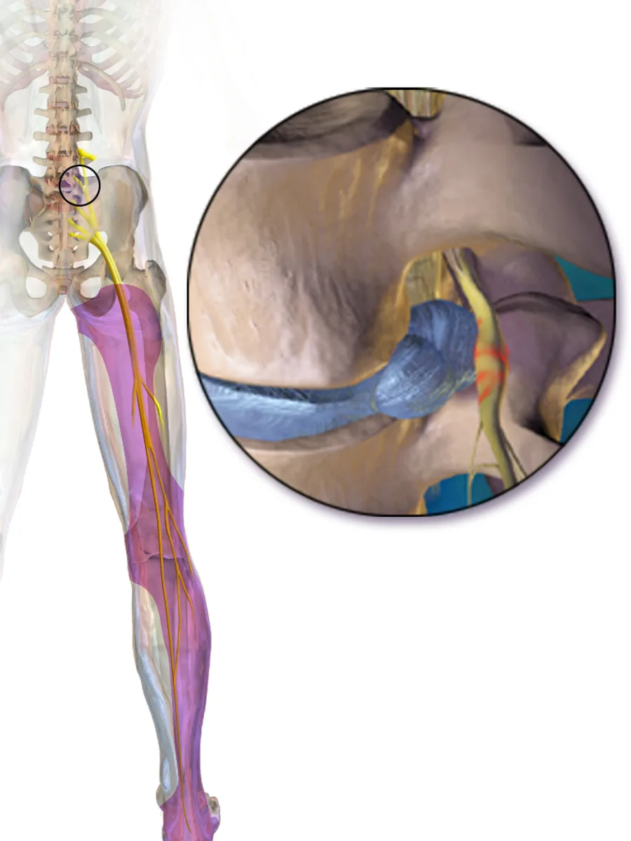 Illustration of a herniated lumbar disc compressing a nerve root, with the sciatic nerve and its pain path down the leg highlighted